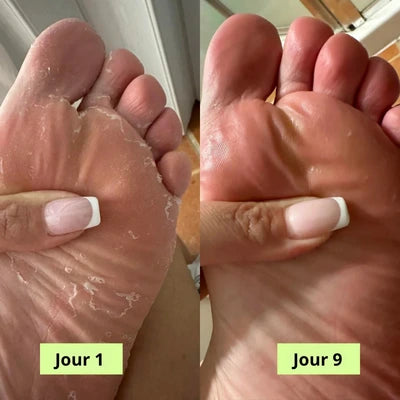 Savon Purifiant Antifongique (Anti-Mycoses)