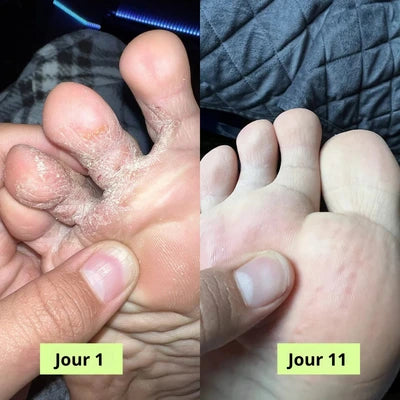 Savon Purifiant Antifongique (Anti-Mycoses)